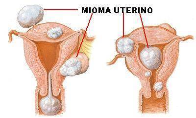 mioma uterino