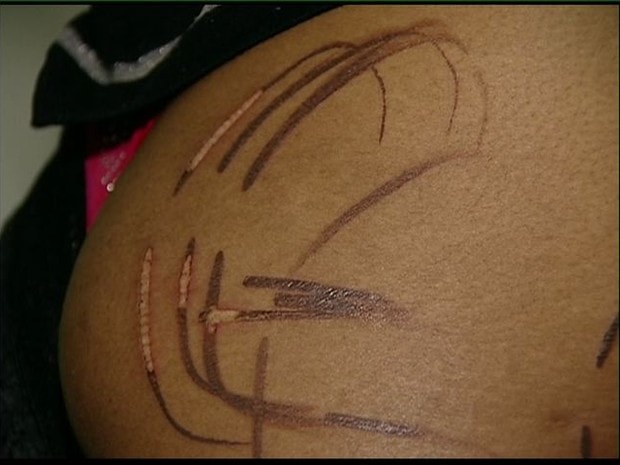 Jovem é marcada com ferro quente pelo namorado no ES, diz mãe
