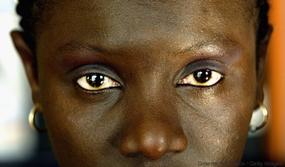 New Measures To Prohibit Female Circumcision Announced In London